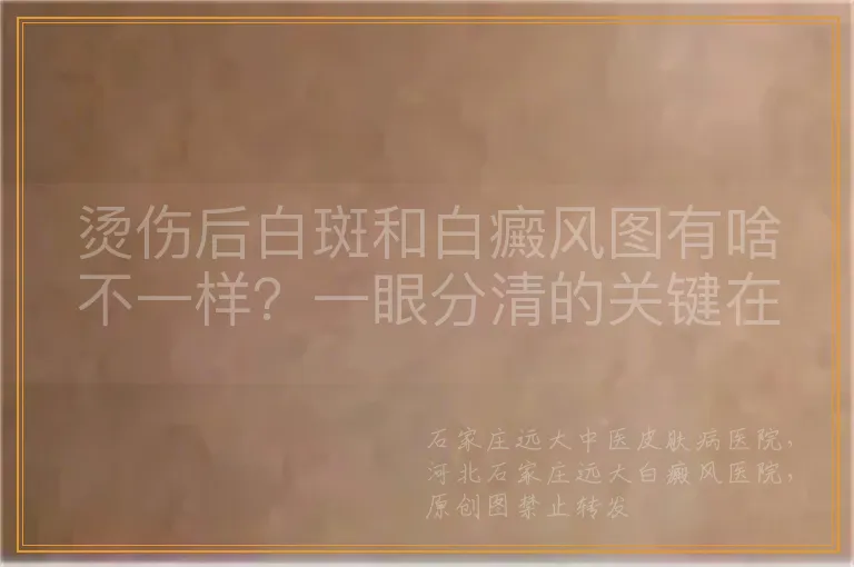 烫伤后白斑和白癜风图有啥不一样？一眼分清的关键在这