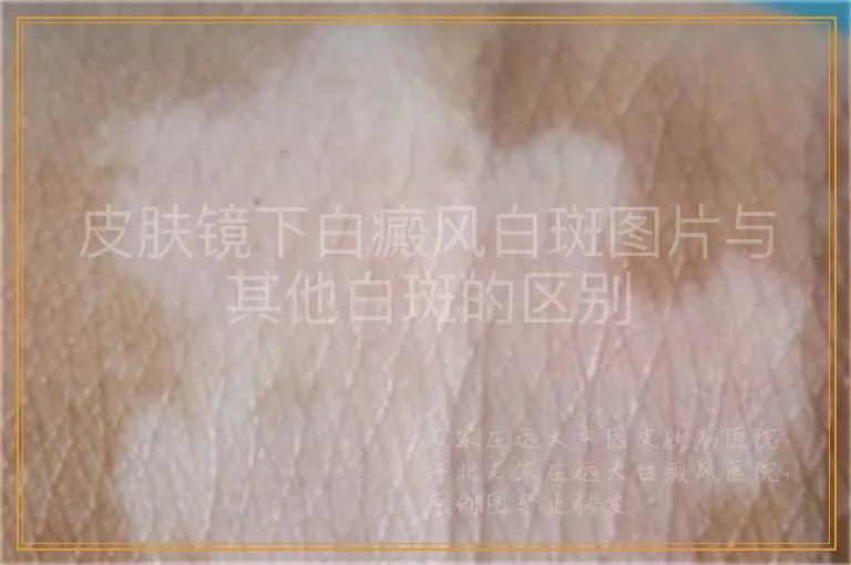 皮肤镜下白癜风白斑图片与其他白斑的区别