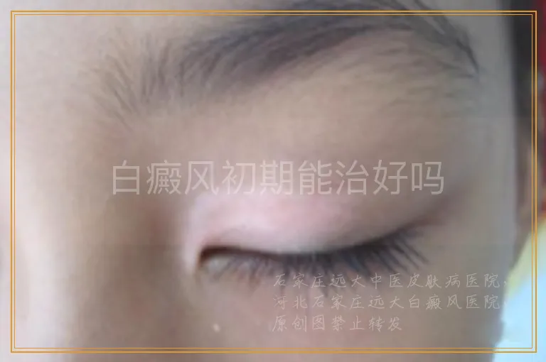 白癜风初期能治好吗