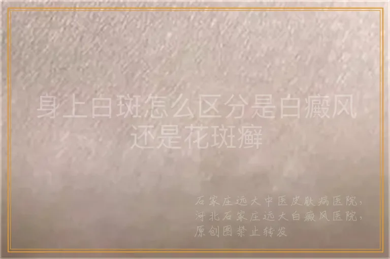 身上白斑怎么区分是白癜风还是花斑癣