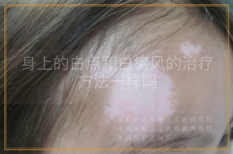 身上的白点和白癜风的治疗方法一样吗