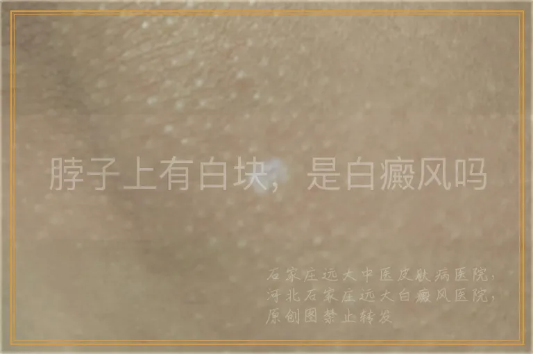 脖子上有白块，是白癜风吗