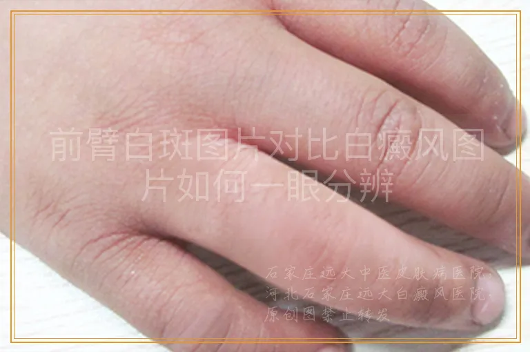 前臂白斑图片对比白癜风图片如何一眼分辨