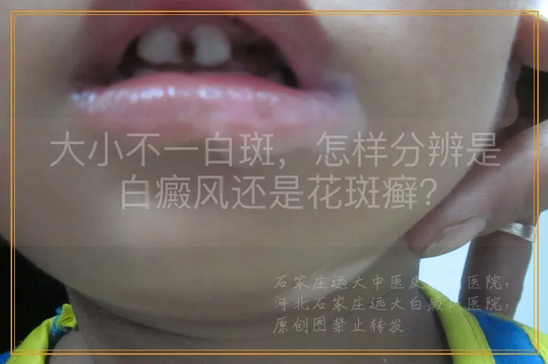 大小不一白斑，怎样分辨是白癜风还是花斑癣？
