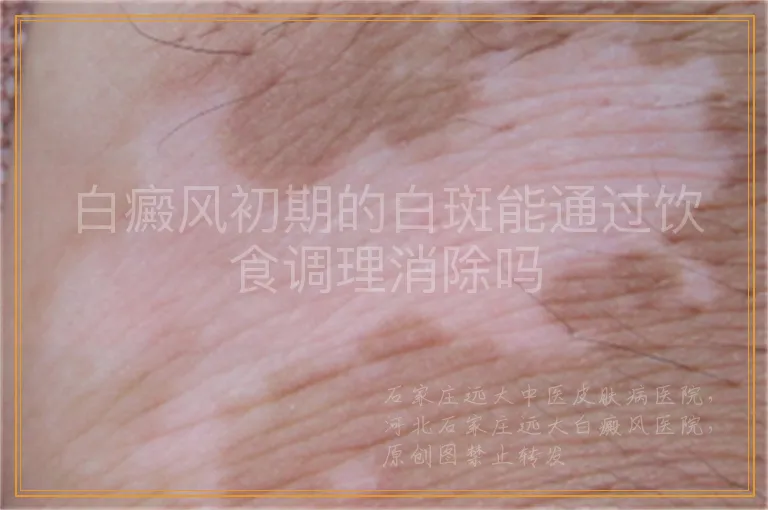 白癜风初期的白斑能通过饮食调理消除吗