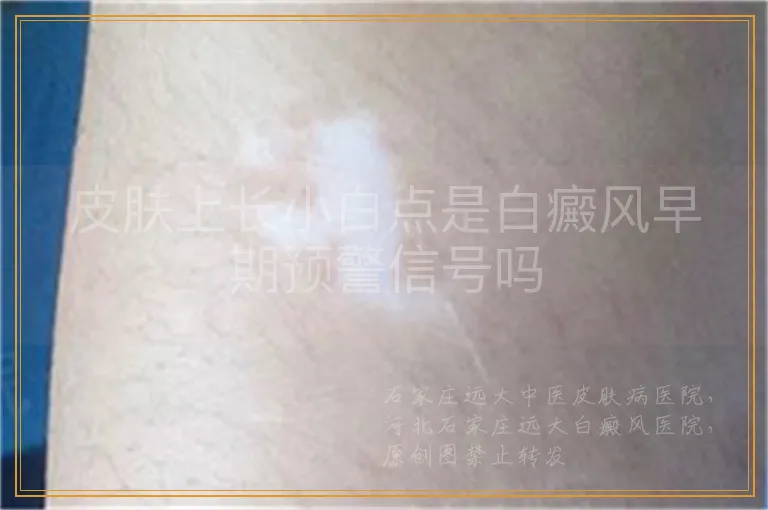 皮肤上长小白点是白癜风早期预警信号吗