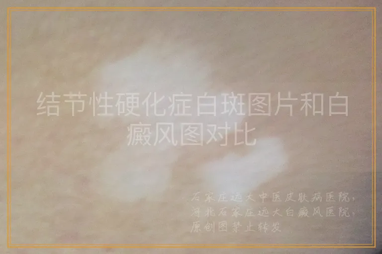 结节性硬化症白斑图片和白癜风图对比
