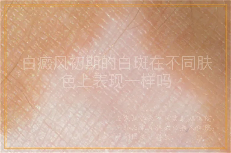 白癜风初期的白斑在不同肤色上表现一样吗