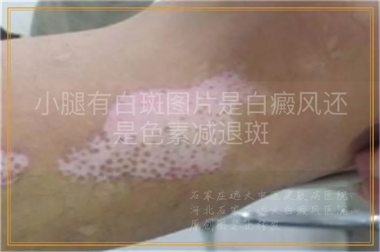 小腿有白斑图片是白癜风还是色素减退斑
