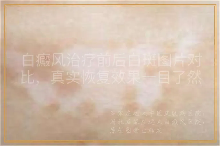白癜风治疗前后白斑图片对比，真实恢复效果一目了然