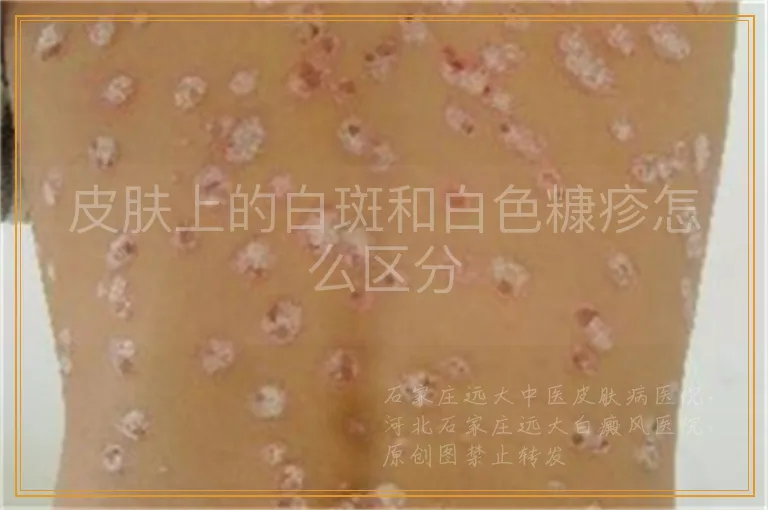 皮肤上的白斑和白色糠疹怎么区分