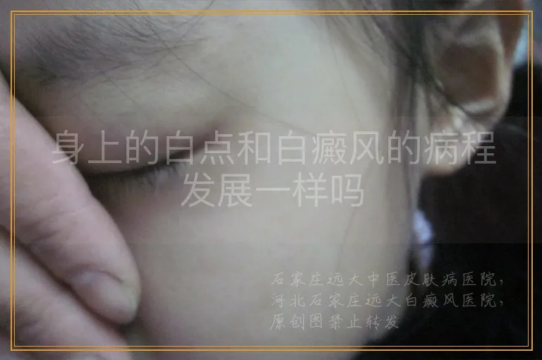 身上的白点和白癜风的病程发展一样吗