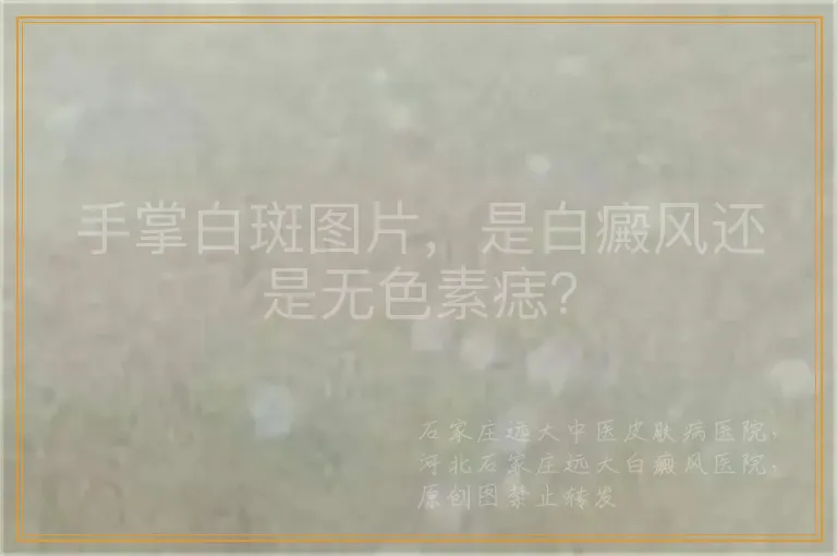 手掌白斑图片，是白癜风还是无色素痣？