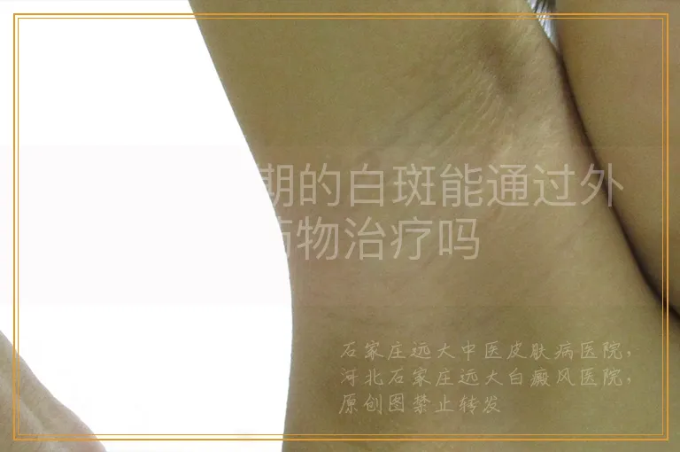 白癜风初期的白斑能通过外用药物治疗吗