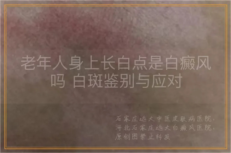 老年人身上长白点是白癜风吗 白斑鉴别与应对