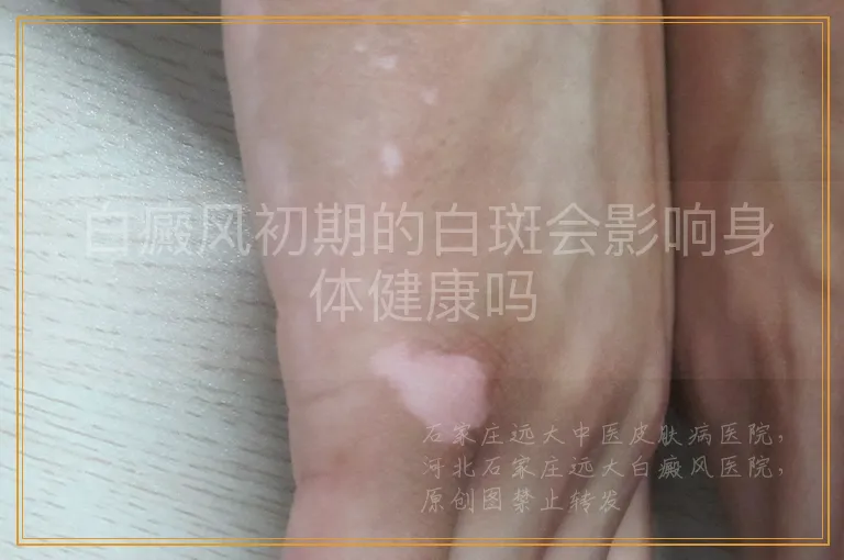 白癜风初期的白斑会影响身体健康吗