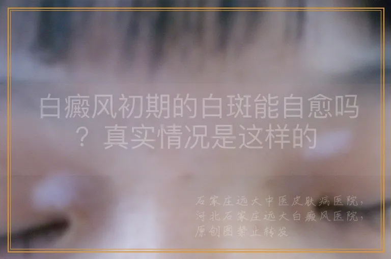 白癜风初期的白斑能自愈吗？真实情况是这样的