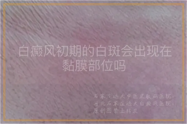 白癜风初期的白斑会出现在黏膜部位吗