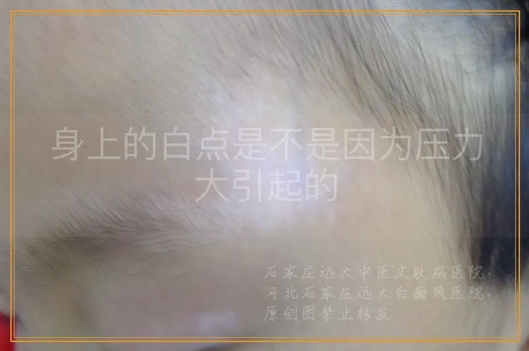 身上的白点是不是因为压力大引起的