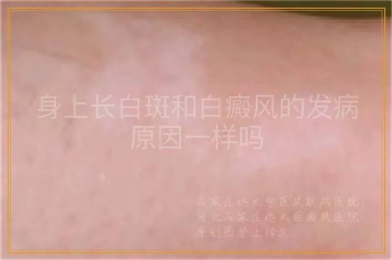 身上长白斑和白癜风的发病原因一样吗