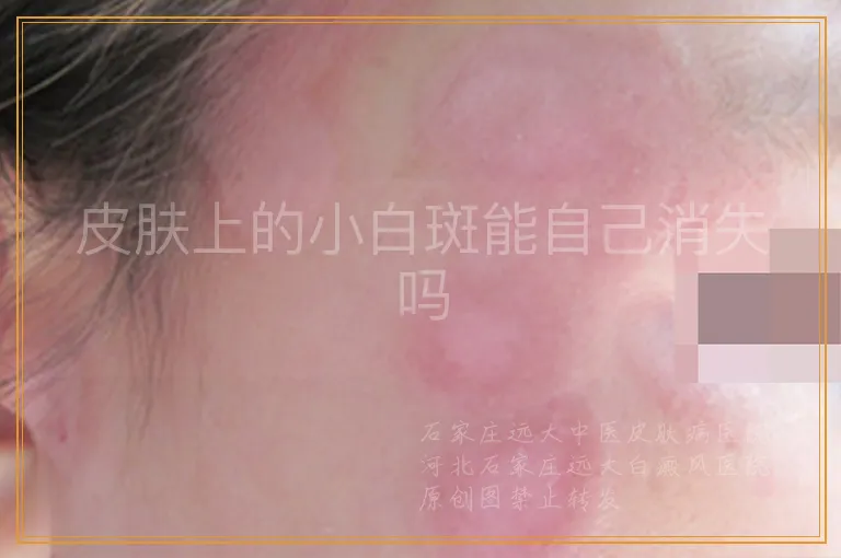 皮肤上的小白斑能自己消失吗