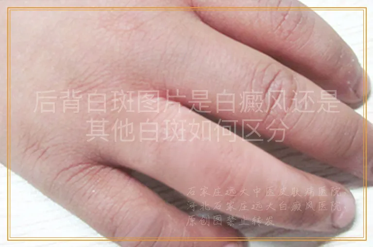 后背白斑图片是白癜风还是其他白斑如何区分