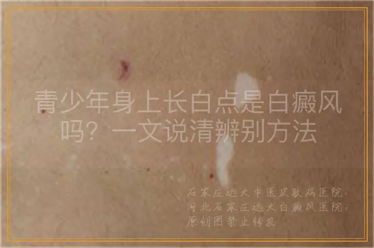 青少年身上长白点是白癜风吗？一文说清辨别方法