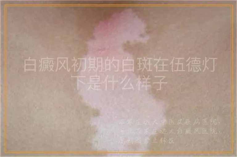 白癜风初期的白斑在伍德灯下是什么样子
