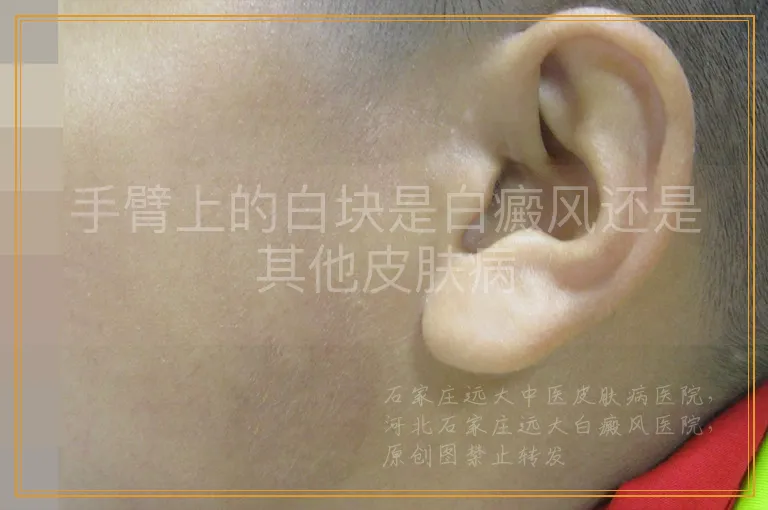 手臂上的白块是白癜风还是其他皮肤病