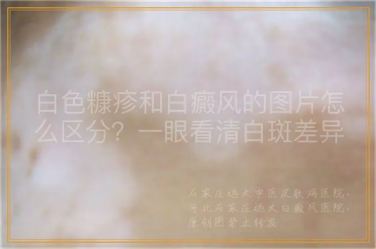 白色糠疹和白癜风的图片怎么区分？一眼看清白斑差异