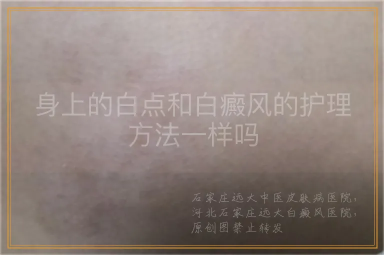 身上的白点和白癜风的护理方法一样吗