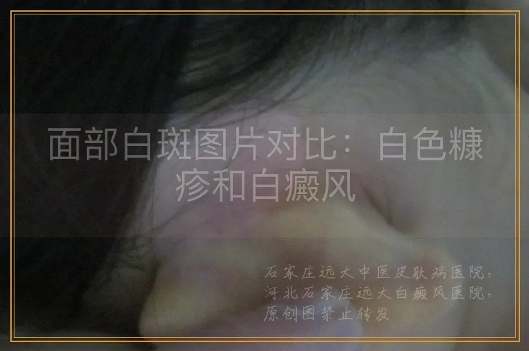 面部白斑图片对比：白色糠疹和白癜风