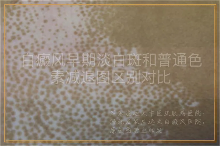白癜风早期淡白斑和普通色素减退图区别对比