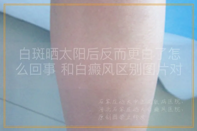 白斑晒太阳后反而更白了怎么回事 和白癜风区别图片对比
