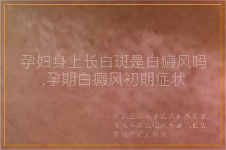 孕妇身上长白斑是白癜风吗,孕期白癜风初期症状