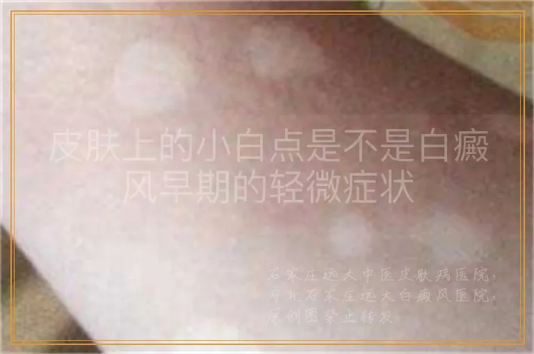 皮肤上的小白点是不是白癜风早期的轻微症状