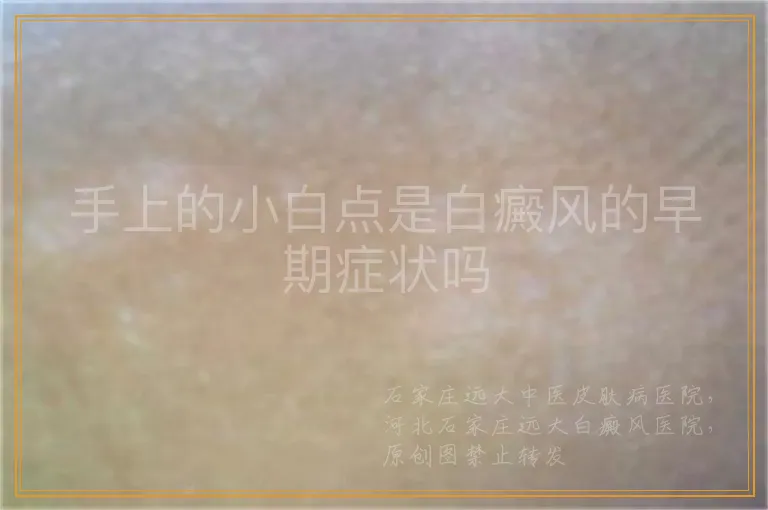 手上的小白点是白癜风的早期症状吗