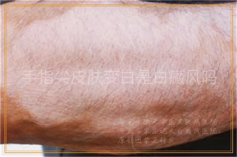 手指尖皮肤变白是白癜风吗