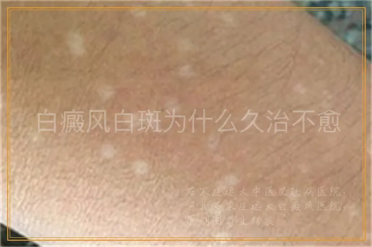 白癜风白斑为什么久治不愈