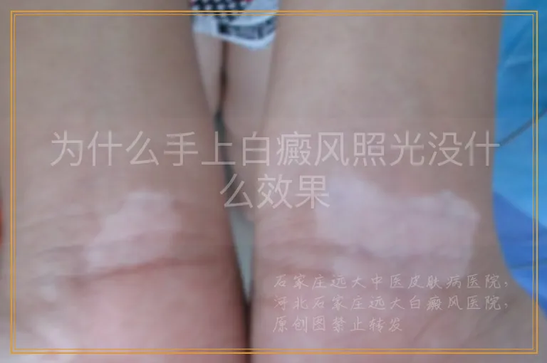 为什么手上白癜风照光没什么效果