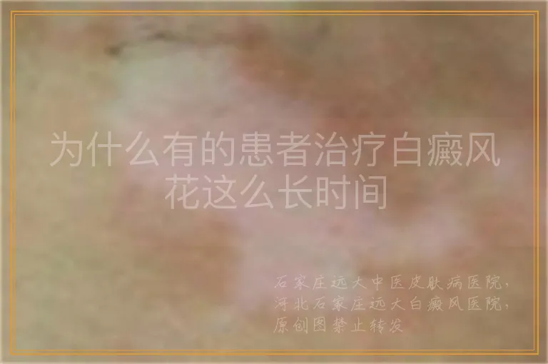 为什么有的患者治疗白癜风花这么长时间