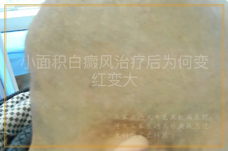 小面积白癜风治疗后为何变红变大