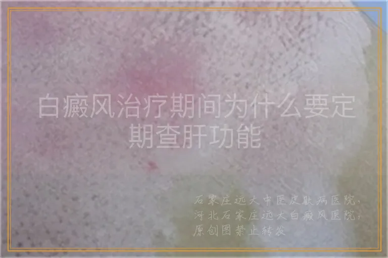 白癜风治疗期间为什么要定期查肝功能