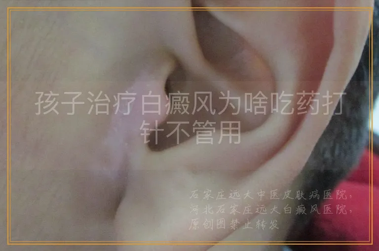 孩子治疗白癜风为啥吃药打针不管用