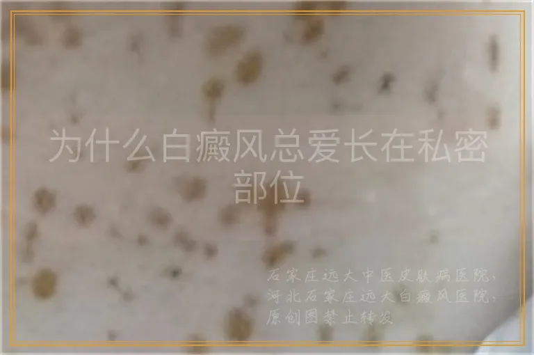 为什么白癜风总爱长在私密部位
