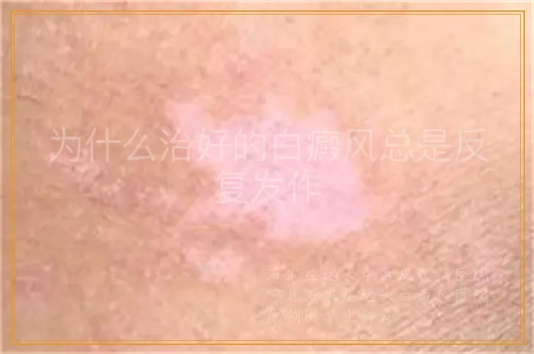 为什么治好的白癜风总是反复发作