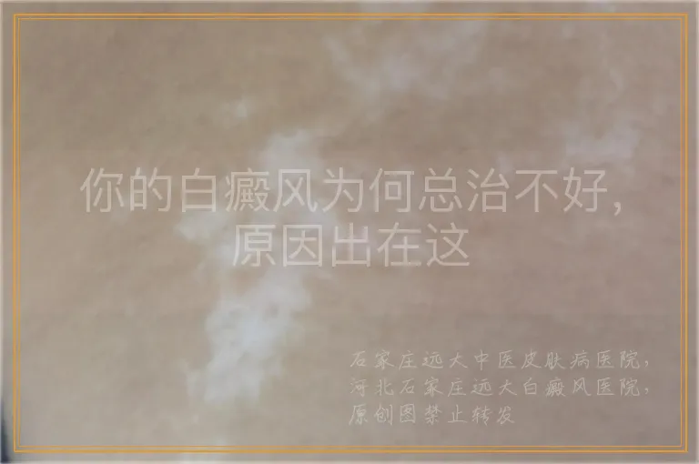 你的白癜风为何总治不好，原因出在这