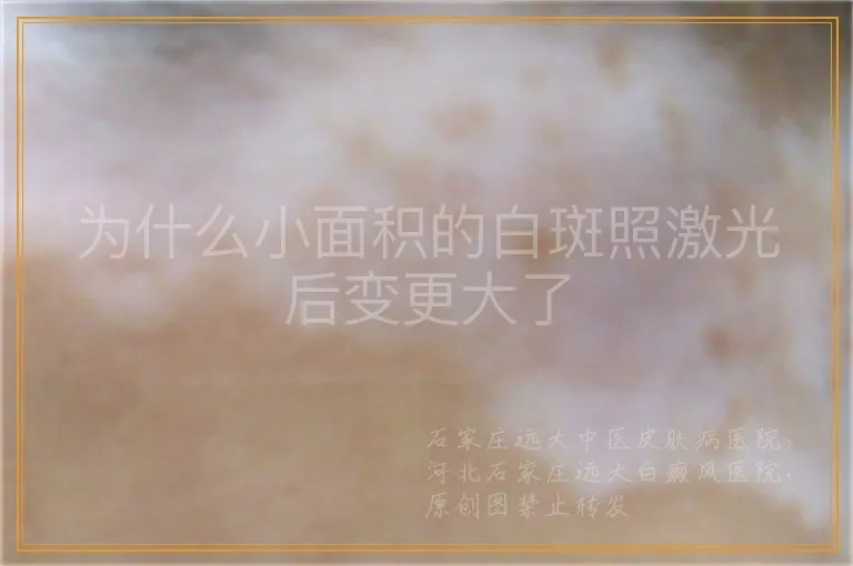 为什么小面积的白斑照激光后变更大了