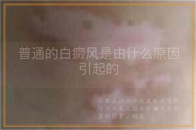 普通的白癜风是由什么原因引起的