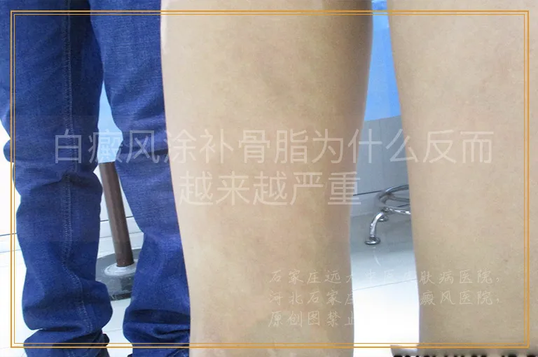 白癜风涂补骨脂为什么反而越来越严重